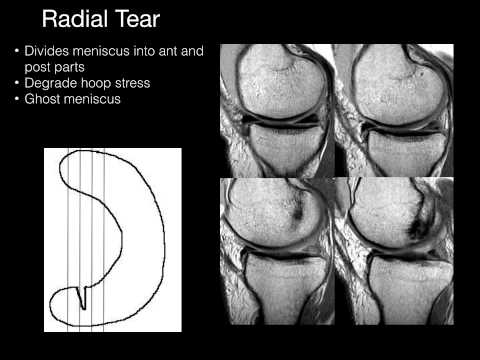 Видео: Мениски коленного сустава, автор — Джеффри Райли, доктор медицины.