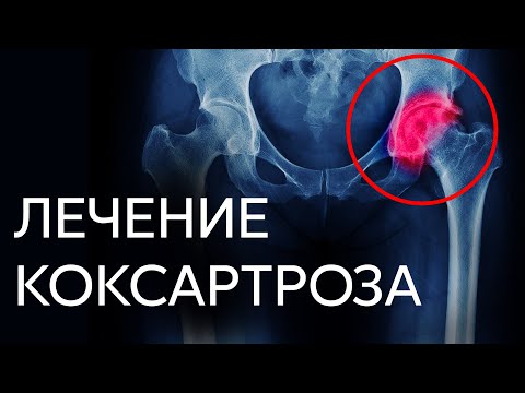Видео: ЛЕЧЕНИЕ КОКСАРТРОЗА | Доктор Черкасов