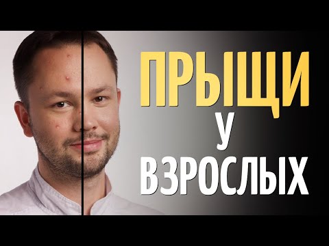 Видео: ТОП 8 причин АКНЕ на лице