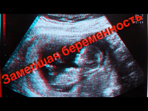Видео: Замершая беременность после ЭКО/ моя грустная история