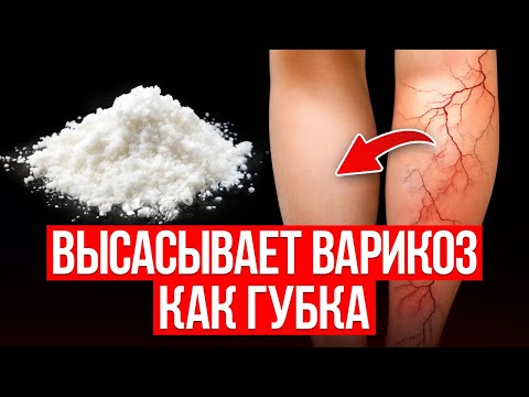 Видео: Варикоз не уходит? Вот настоящая ПРИЧИНА, почему лечение не помогает и что делать