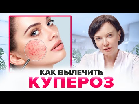 Видео: Как вылечить КУПЕРОЗ | Ирина Рахова