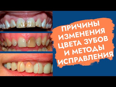 Видео: Зуб изменил цвет. Зуб потемнел. Причины. Как помочь?