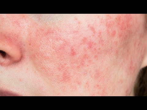 Видео: РОЗАЦЕА прямой эфир в записи: лечение (описание⬇️)