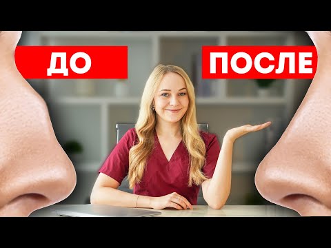 Видео: Как Убрать Горбинку на Носу: Все Способы