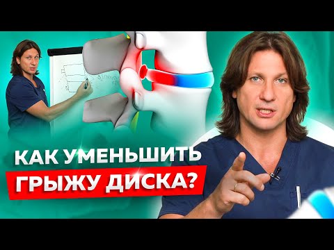 Видео: Как уменьшить грыжу межпозвоночного диска. Что нельзя делать при грыже?