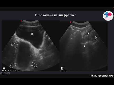 Видео: eFAST протокол   ошибки и подводные камни метода