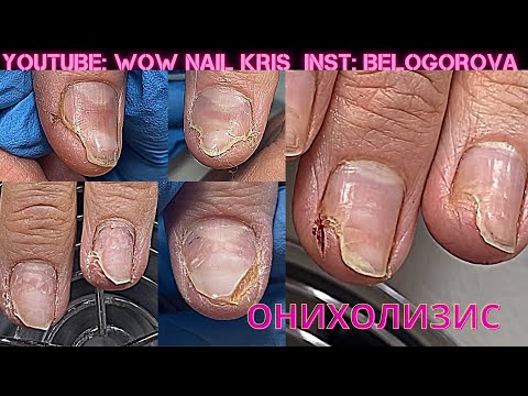 Видео: Осталась без ногтей совсем😱|Часть 2|Онихолизис на всех ногтях|Пробуем разные способы восстановления