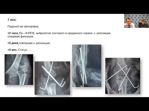 Видео: Чрезмыщелковые переломы у детей как мультидисциплинарная проблема