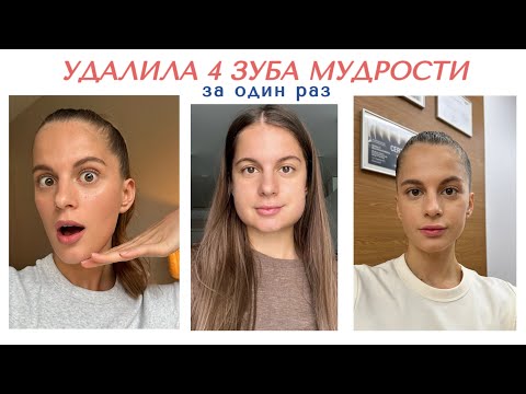 Видео: VLOG: удалила 4 зуба мудрости под седацией, моя реабилитация, сколько стоит?