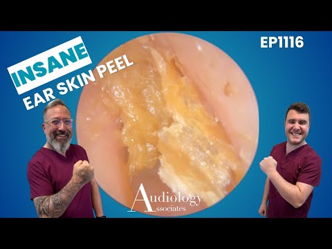 Видео: БЕЗУМНЫЙ пилинг для кожи ушей! Глубокое удаление ороговевших клеток! 👂😱 - EP1116