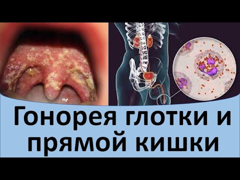 Видео: Гонорея глотки и прямой кишки