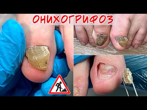 Видео: Онихогрифоз / Криво растет ноготь на ноге