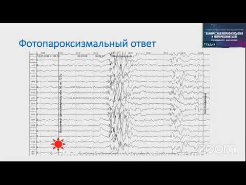 Видео: Особенности ЭЭГ при приступах с генерализованным началом. Ноговицын В Ю  Москва.