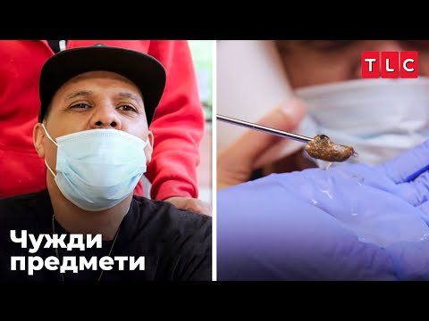 Видео: Втвърдена ушна кал | Чужди предмети