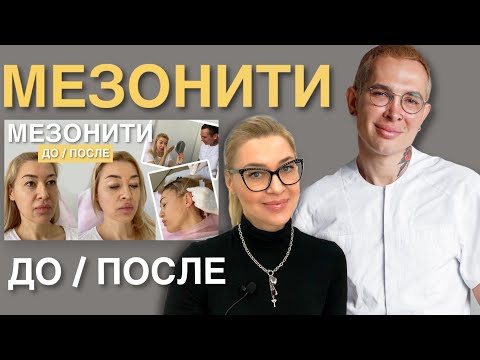 Видео: МЕЗОНИТИ ДО и ПОСЛЕ спустя 9 месяцев #мезонити #подтяжкалица