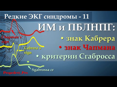 Видео: ЭКГ при инфаркте миокарда (ИМ) и полной блокаде левой ножки пучка Гиса (ПБЛНПГ).