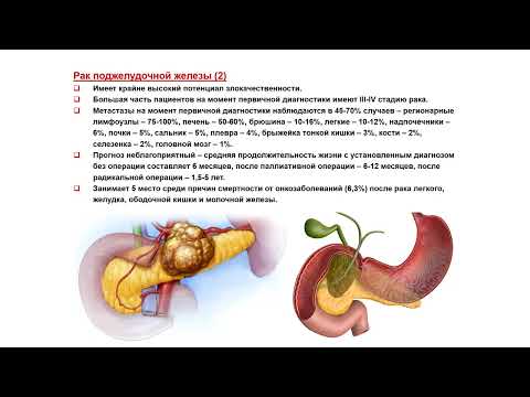 Видео: УЗИ. Доктор Иогансен. Выпуск 56. Злокачественные опухоли поджелудочной железы. Часть 1.