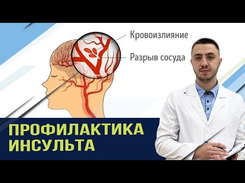 Видео: Профилактика инсульта. Улучшение мозгового кровообращения