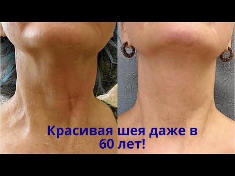 Видео: Подтяжка шеи и декольте! Красивая кожа даже в 60 лет! Недорогие аптечные средства вместо косметики!