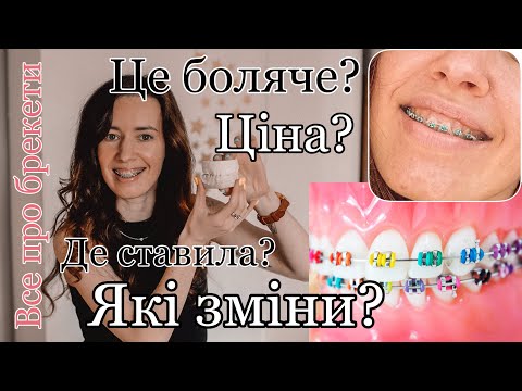 Видео: Чи боляче ставити брекети? Чому болять зуби? Скільки коштують брекети? | KrissTinn