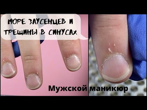Видео: Мужской маникюр 💅 Море заусенцев и трещины в синусах