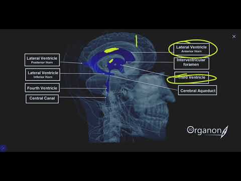 Видео: Мальформация Денди-Уокера. МРТ.УЗИ.