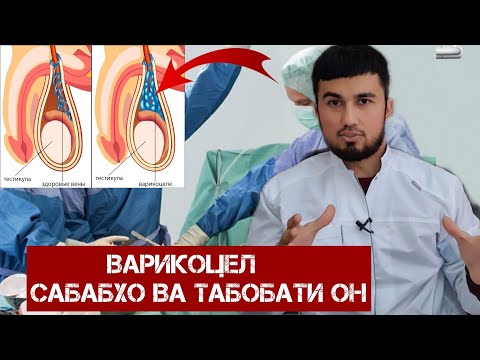 Видео: Варикоцел-сабабхо ва табобати он