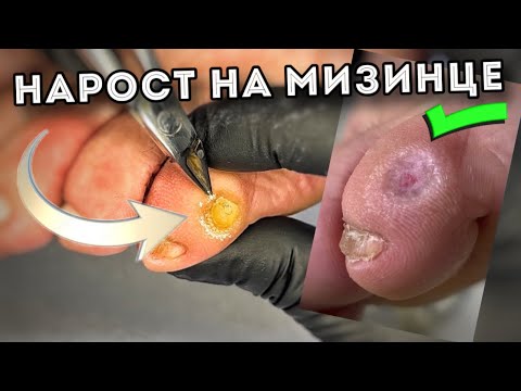 Видео: Крупный нарост на мизинце | причина возникновения | удаление за пару минут