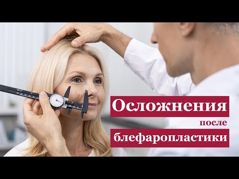 Видео: Осложнения после блефаропластики. Слепота и "рыбий" глаз.
