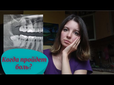 Видео: Осложнения После удаления зуба Мудрости. Онемевший язык. Альвиовит. Мой опыт удаления.