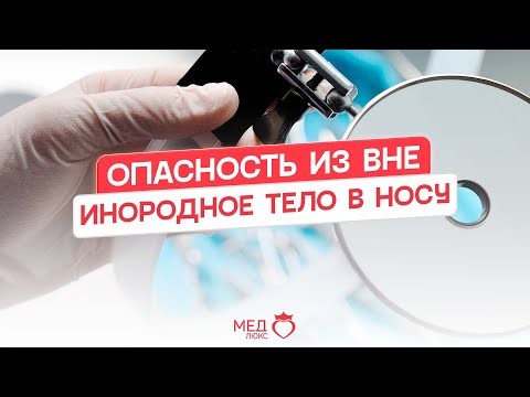 Видео: Опасность из вне | ИНОРОДНОЕ ТЕЛО В НОСУ И КАК ЕГО УБРАТЬ