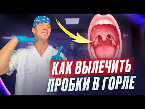 Видео: Белые пробки в гландах. Хронический тонзиллит. Миндалины. Как их лечить.