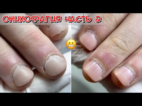 Видео: Онихофагия Что это? Часть 2 / Как лечить? / Грызет ногти подросток / Поможет наращивание грызуну?