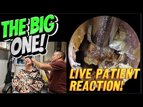 Видео: ГЛАВНОЕ! ЧАСТЬ 1 ЭПИЗОД 300! #ухо #ушнаясера #удалениеушнойсеры #fyp #asmr #длятебя #длятебя