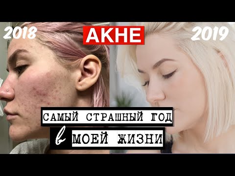 Видео: СПАСИТЕ МЕНЯ ОТ АКНЕ | ИСТОРИЯ ЛЕЧЕНИЯ