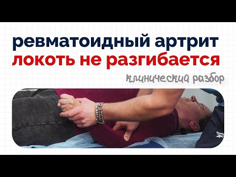 Видео: Локоть не гнется - ревматоидный артрит | Клинический разбор