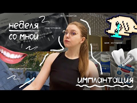Видео: неделя со мной влог | имплантация зубов straumann, моя история, восстановление