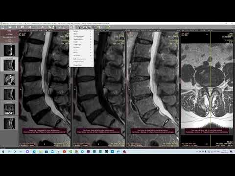 Видео: МРТ ПОП кисты, гемангиома, как описать МРТ ПОП