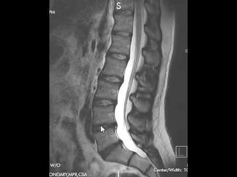 Видео: Как читать МРТ поясничного отдела позвоночника | Первый взгляд на МРТ