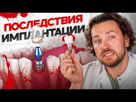 Видео: Самые распространенные ПРОБЛЕМЫ после имплантации зубов / Последствия имплантации и осложнения