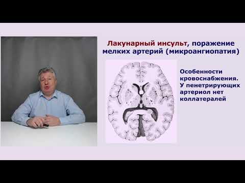 Видео: Редкий вариант сосудистой деменции (микроангиопатия).