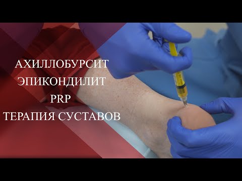 Видео: 💉Бурсит ахиллова сухожилия и эпикондилит | PRP терапия суставов