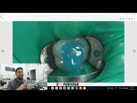 Видео: ВКЛАДКА ИЛИ ШТИФТ? КАК ВОССТАНАВЛИВАТЬ ЗУБ?