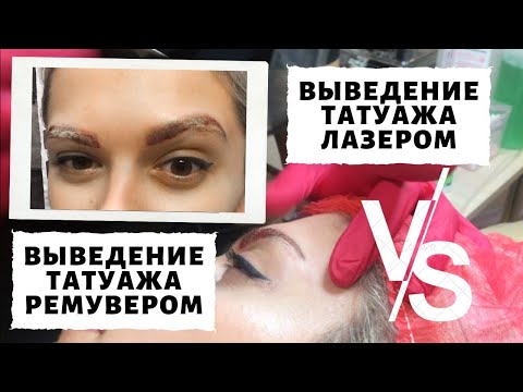 Видео: УДАЛЕНИЕ СТАРОГО ТАТУАЖА РЕМУВЕРОМ! Что лучше ремувер или лазер? Мой опыт!