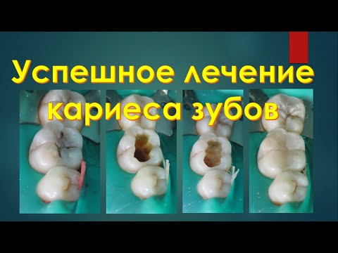 Видео: Секреты Стоматологии - Глава 2. Лечение Кариеса
