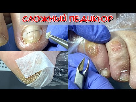 Видео: Сухая мозоль на мизинце ноги / Трещины на пятках