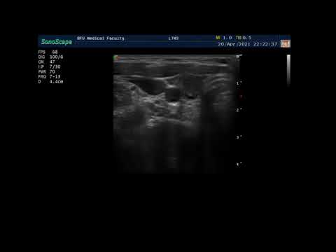 Видео: Узи щитовидной железы. Пациент 3