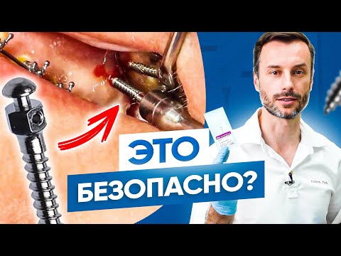 Видео: Установка микровинта для брекетов в десне. Микроимплантация в современной ортодонтии