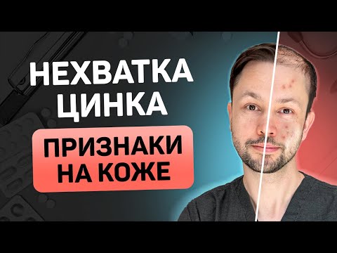 Видео: Цинк - мощный ингредиент от выпадение волос и акне